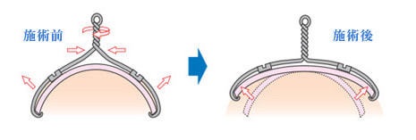 VHO式矯正技術の仕組み｜巻き爪を痛みなく矯正